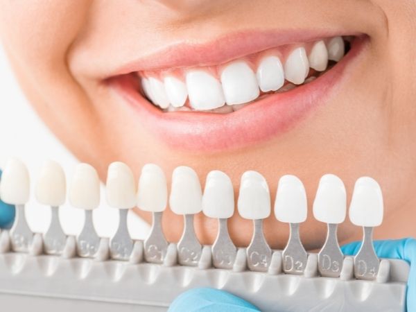 professional teeth whitening near me Clifton Dental Care